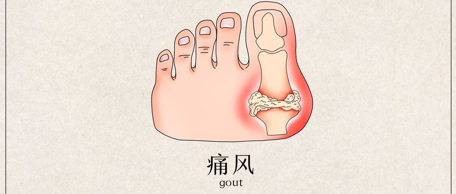摄图网_401790423_wx_痛风医疗插画（非企业商用）.jpg